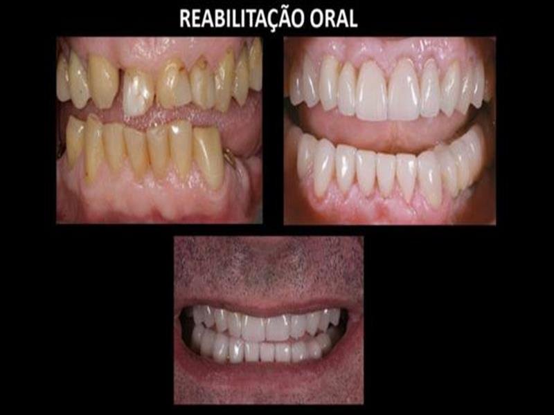 Estética dental - Facetas de porcelana e clareamento
