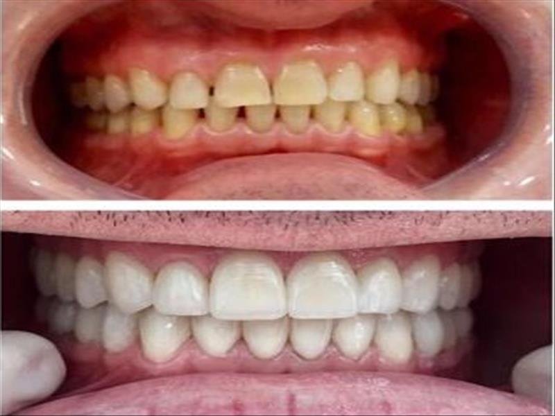 Estética dental - Facetas de porcelana e clareamento